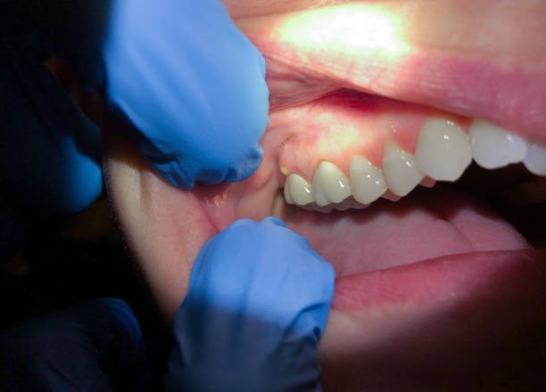 Best Dentist for Tooth Abscess  in Sissonville, WV